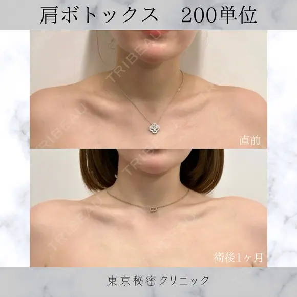 肩ボトックス　200単位 after画像 メイン用