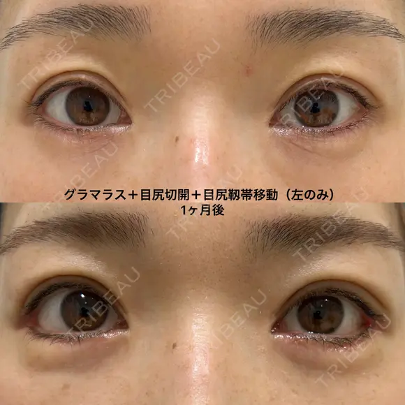 外側を下げるたれ目形成 30日後 メイン用