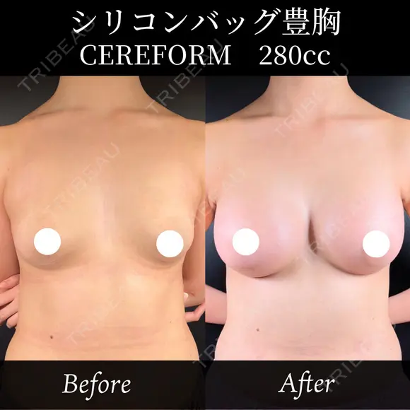 豊胸術－シリコンバッグ豊胸－ after画像 メイン用