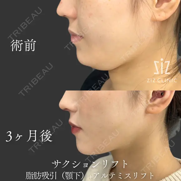 【サクションリフト】ミニ脂肪吸引(顎下)+アルテミスリフト before画像 メイン用