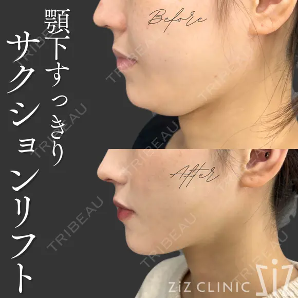【サクションリフト】ミニ脂肪吸引(顎下)+アルテミスリフト after画像 メイン用