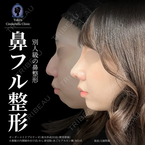 オーダーメイドプロテーゼ＋鼻尖形成3D法＋軟骨移植＋小鼻縮小内側締め付け法＋わし鼻切除＋あごヒアルロン酸※MD式 before画像 メイン用