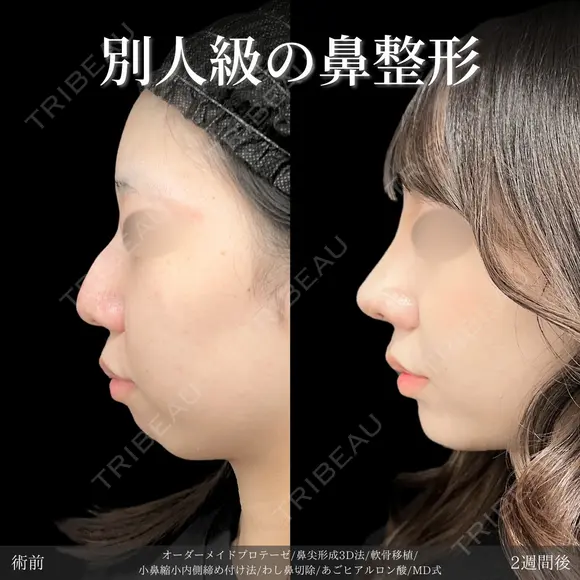 オーダーメイドプロテーゼ＋鼻尖形成3D法＋軟骨移植＋小鼻縮小内側締め付け法＋わし鼻切除＋あごヒアルロン酸※MD式 14日後 メイン用