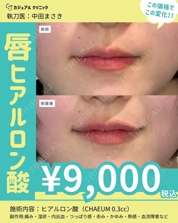 唇ヒアルロン酸 before画像 メイン用