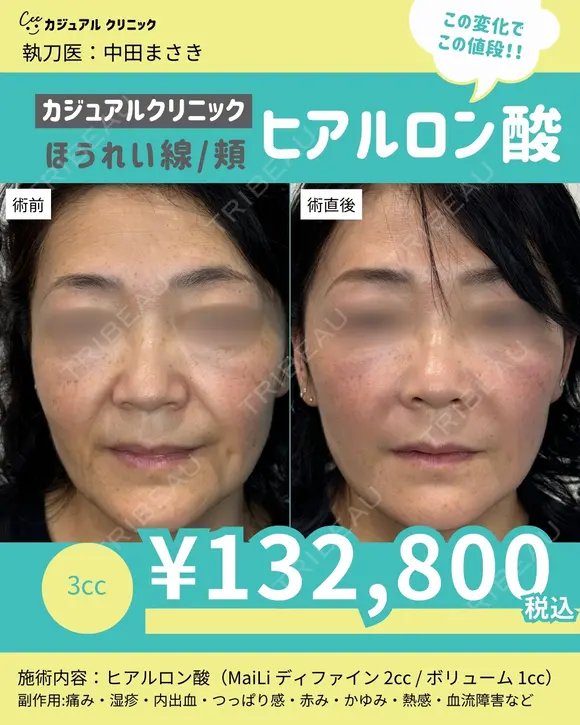 ほうれい線/頬 ヒアルロン酸 before画像 メイン用