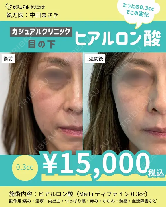 目の下ヒアルロン酸 before画像 メイン用