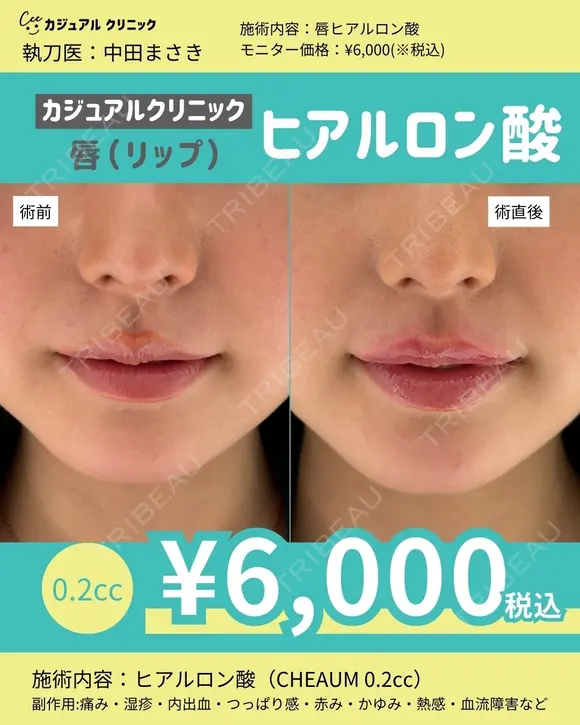 唇ヒアルロン酸 before画像 メイン用