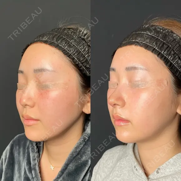 定額鼻整形 before画像 メイン用