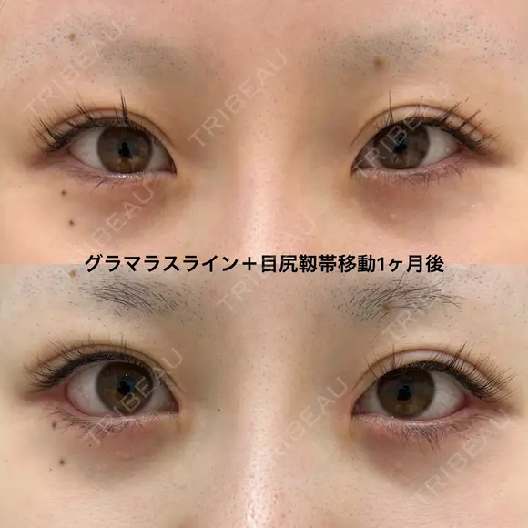 たれ目形成 before画像 メイン用