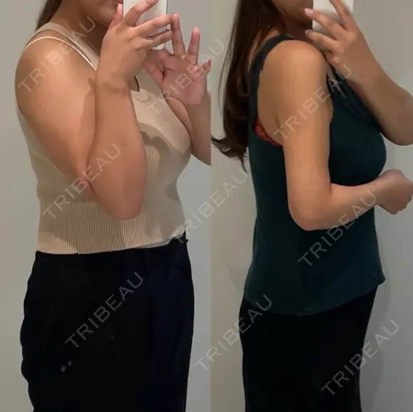 シークレット脂肪吸引二の腕 before画像 メイン用