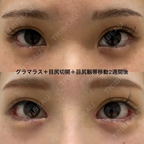 たれ目形成、ナチュラル変化 after画像 メイン用