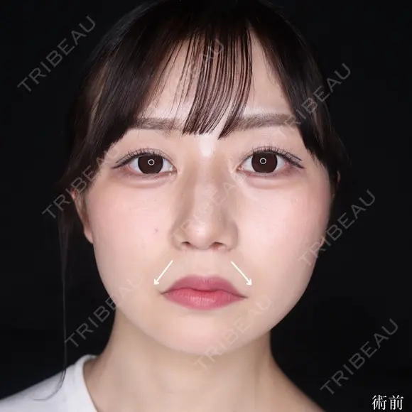 口角挙上 before画像 メイン用