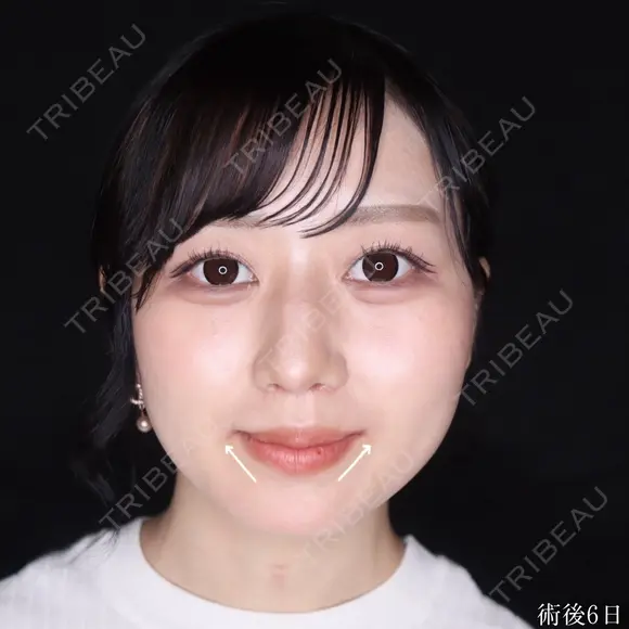 口角挙上 30日後 メイン用
