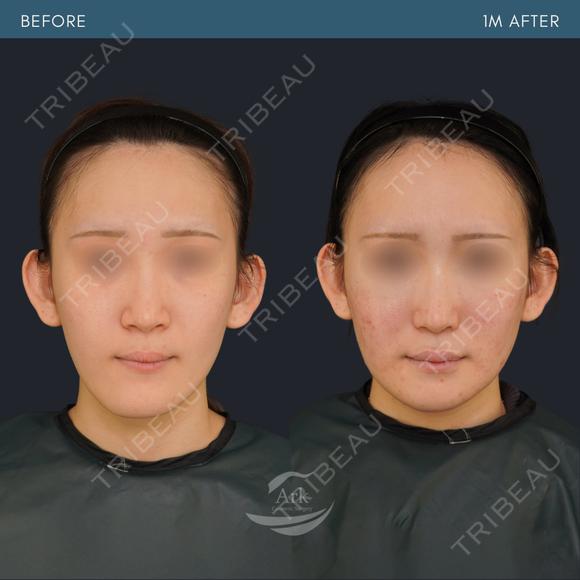 Vライン形成＋外板除去 before画像 メイン用