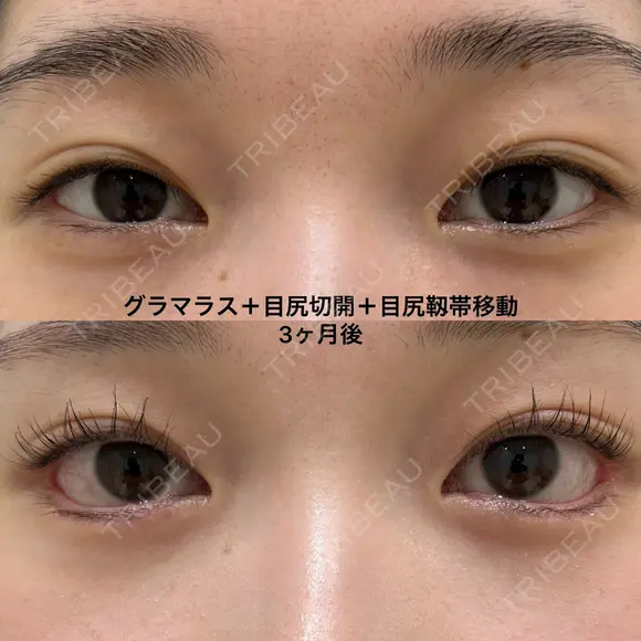 つり目の印象を自然に緩和する、たれ目形成 before画像 メイン用