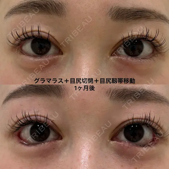 たれ目形成 before画像 メイン用