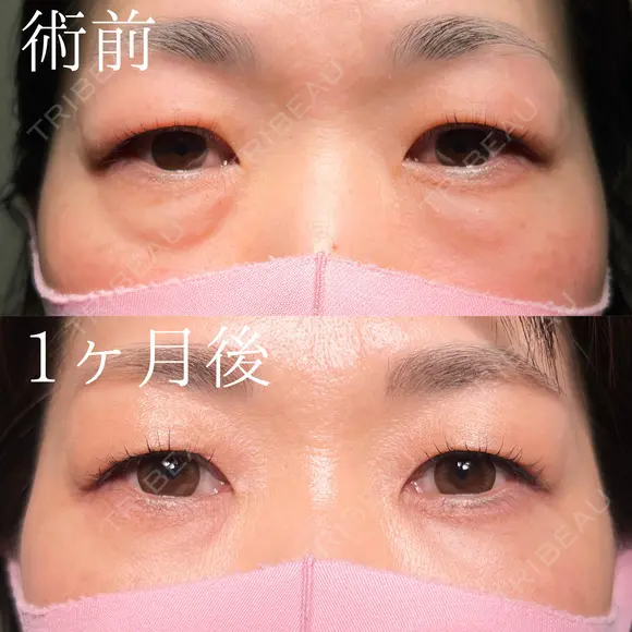 目の下のクマ取り×目の下の脂肪注入×ゴルゴラインの脂肪注入 before画像 メイン用