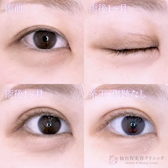 二重埋没 before画像 メイン用