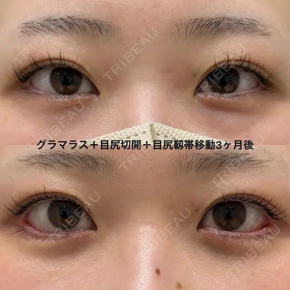たれ目形成、逆さ睫毛気味でもしっかり下げて丸いカーブに after画像 メイン用