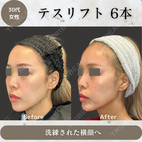 テスリフト before画像 メイン用