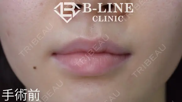 【口唇縮小術（下）】1ヵ月後 before画像 メイン用
