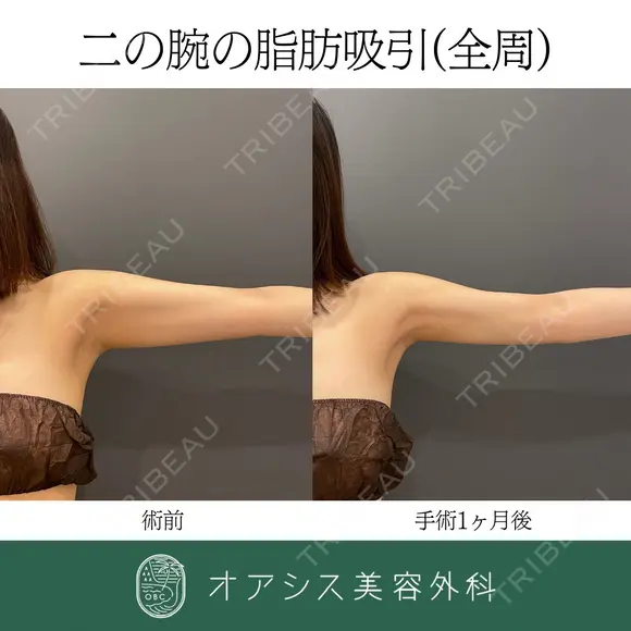 コンプリート脂肪吸引【上腕全周〜お背中の一部】🌴形成外科専門医がご対応✨ after画像 メイン用