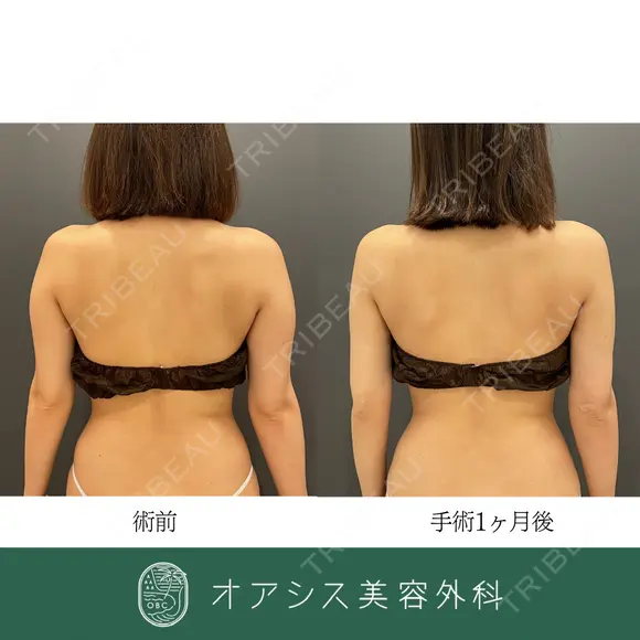コンプリート脂肪吸引【上腕全周〜お背中の一部】🌴形成外科専門医がご対応✨ after画像 メイン用