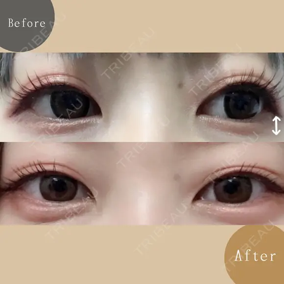 涙袋ヒアルロン酸 after画像 メイン用