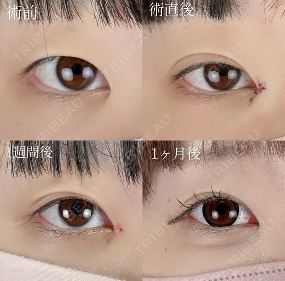 二重埋没/自然癒着法 before画像 メイン用