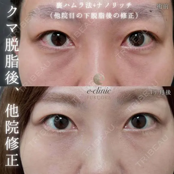 クマ治療 裏ハムラ法	 before画像 メイン用