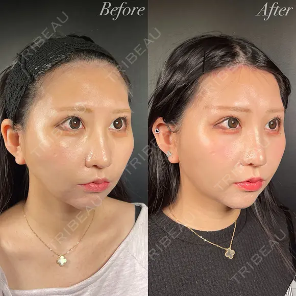 前額リフト before画像 メイン用