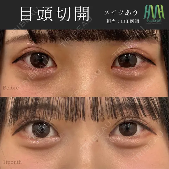 目頭切開 before画像 メイン用