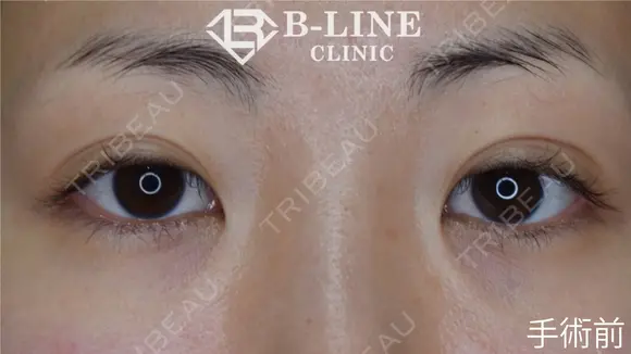 【BL式韓流目頭切開術】3ヵ月後 before画像 メイン用