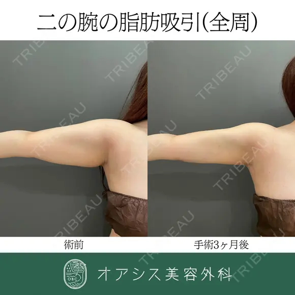 コンプリート脂肪吸引【上腕全周〜背中の一部】 before画像 メイン用