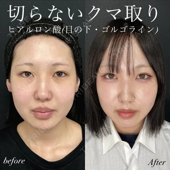 切らないクマ取り＋ヒアルロン酸（目の下・ゴルゴライン） before画像 メイン用
