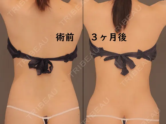 胸下+腹部全体+腰 before画像 メイン用