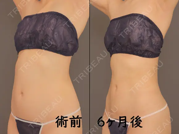 胸下+腹部全体+腰 after画像 メイン用