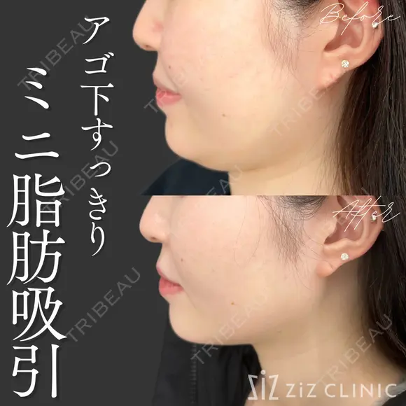 【小顔整形】ミニ脂肪吸引(顎下中央、サイド) after画像 メイン用