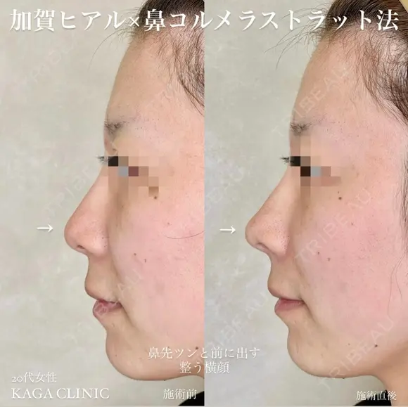 加賀ヒアル×鼻先コルメラストラット法 before画像 メイン用