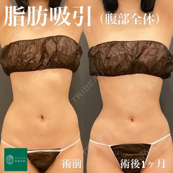 コンプリート脂肪吸引(上下腹部・ウエスト・腰 before画像 メイン用