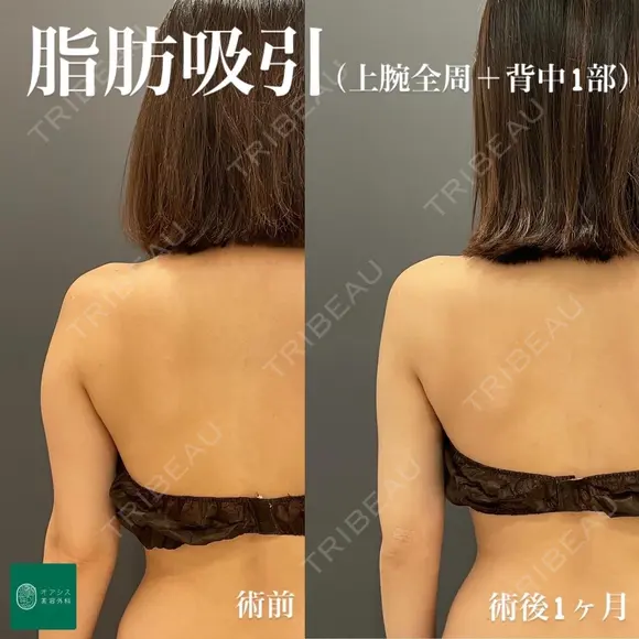 コンプリート脂肪吸引【上腕全周〜背中の一部】 after画像 メイン用