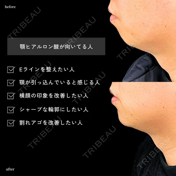 顎のヒアルロン酸 0日後 メイン用