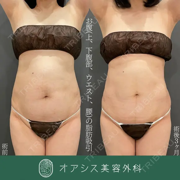 コンプリート脂肪吸引(上下腹部・ウエスト・腰) after画像 メイン用