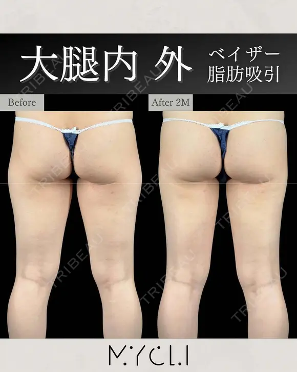 ベイザー脂肪吸引（大腿内・外） before画像 メイン用