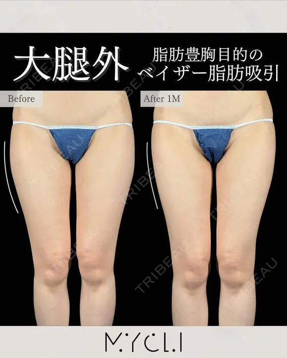 脂肪豊胸目的のベイザー脂肪吸引（大腿外） before画像 メイン用