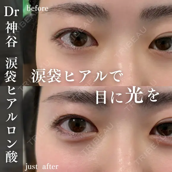 涙袋ヒアルロン酸 after画像 メイン用