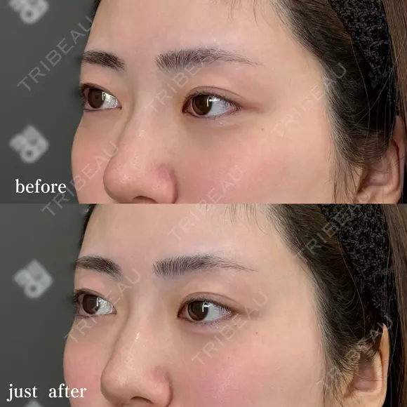 涙袋ヒアルロン酸 after画像 メイン用