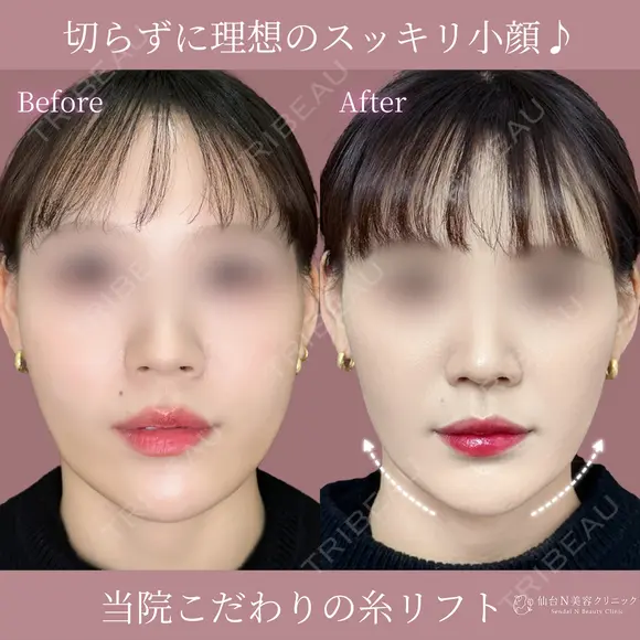 リフト before画像 メイン用