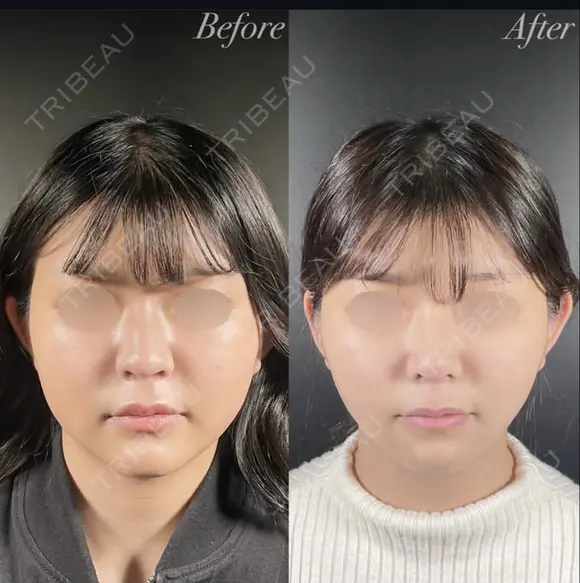 小顔整形－複合－ before画像 メイン用