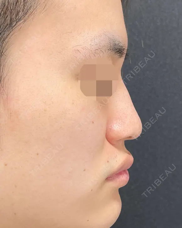 プロテーゼ・鼻尖形成・小鼻縮小 before画像 メイン用